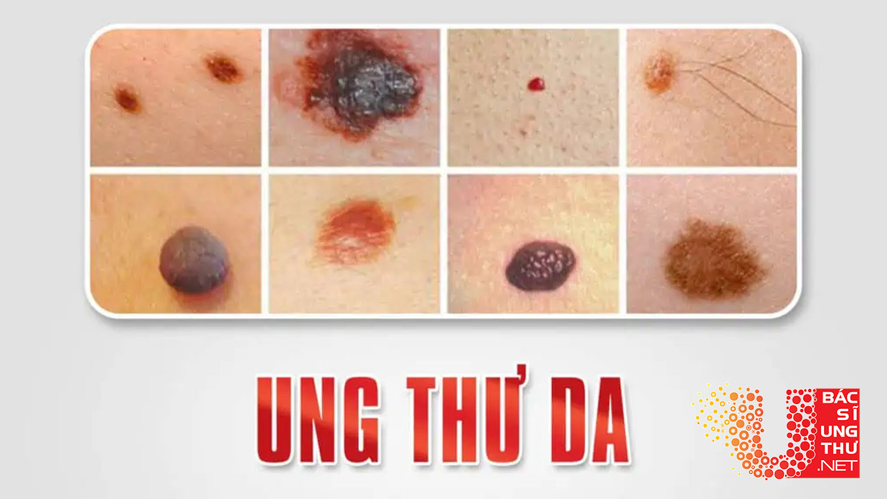 Hiểu rõ Ung thư da, các giai đoạn bệnh và cách phòng chống hiệu quả-Bacsiungthu.net